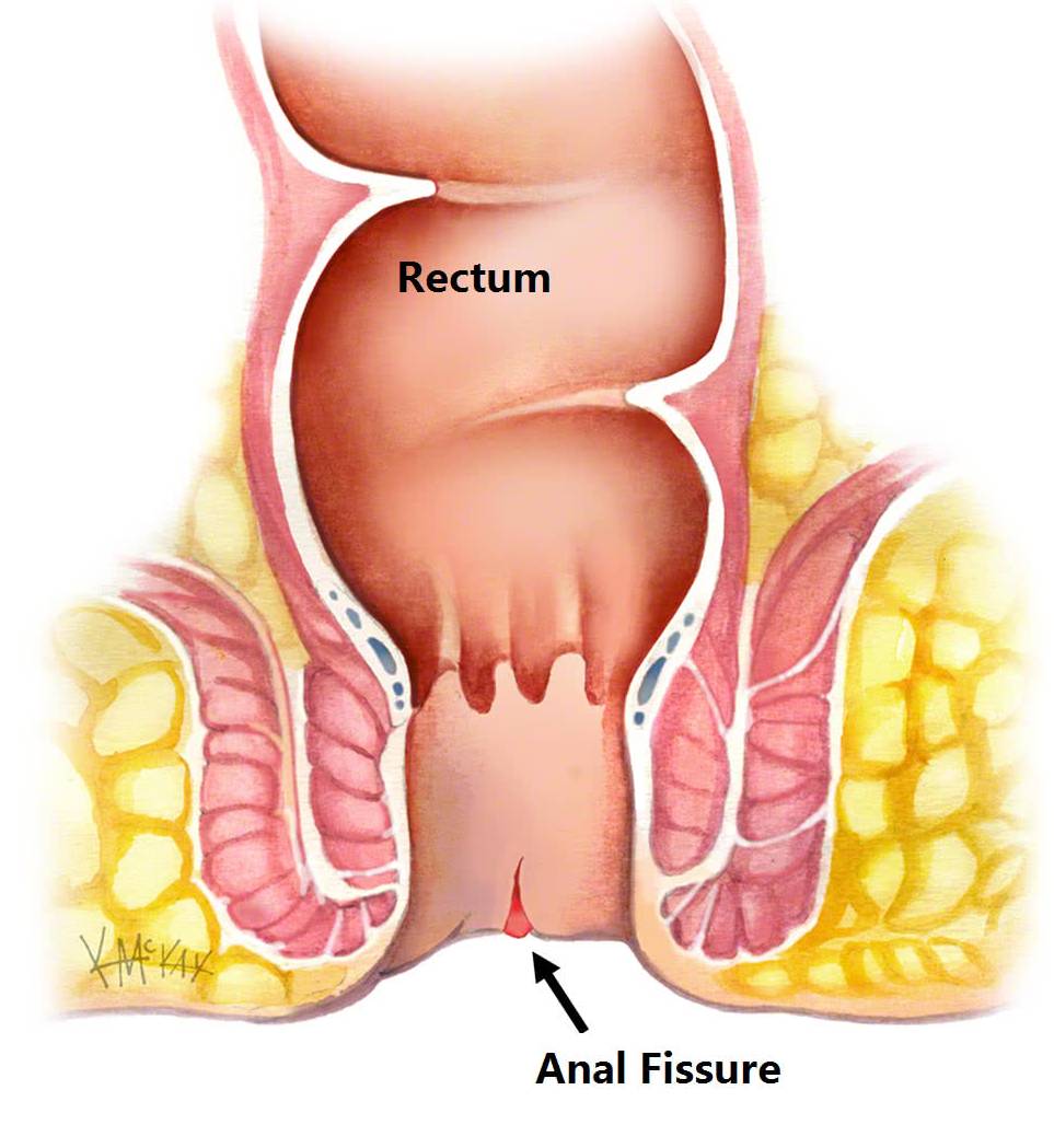 Anal Fissure